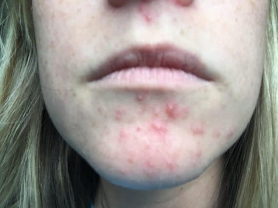 5 Easy Tips That Helped My Perioral Dermatitis Clear Up Quickly 