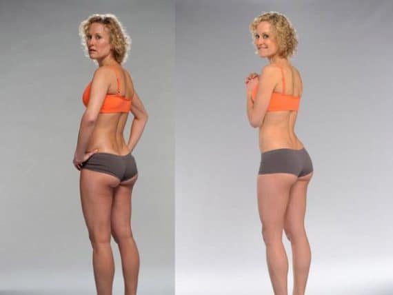 Before And After Pictures Brazilian Buttock Lift