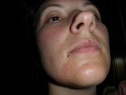 Perioral Dermatitis Before