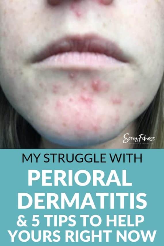 perioral dermatitis chin