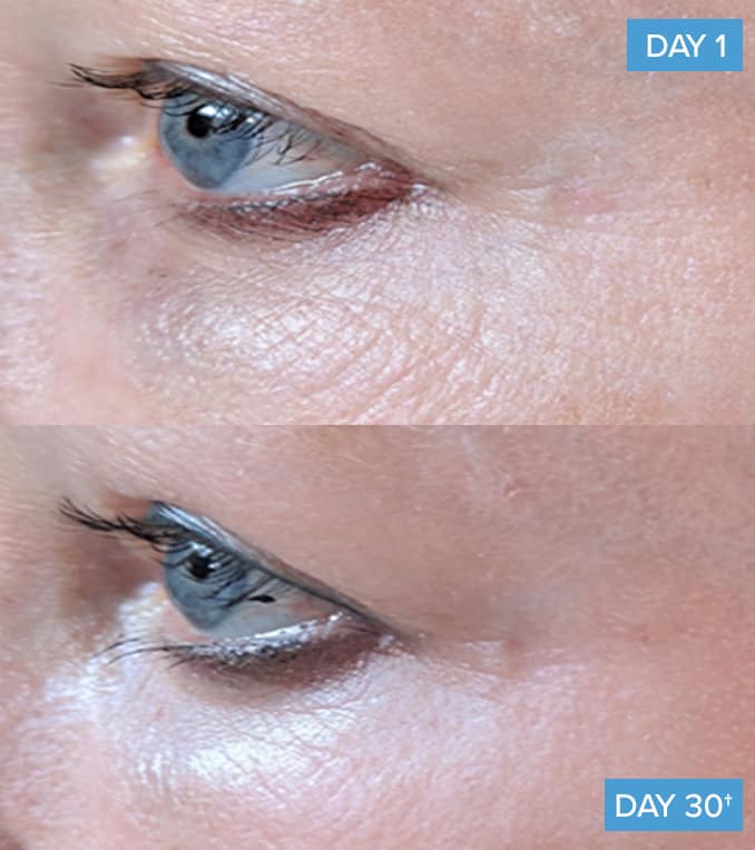 collagen before and after around the eyes