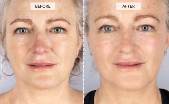 CurrentBody LED Mask Before and After Alessandra