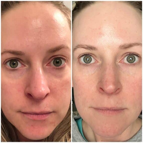 currentbody LED Mask Before and After