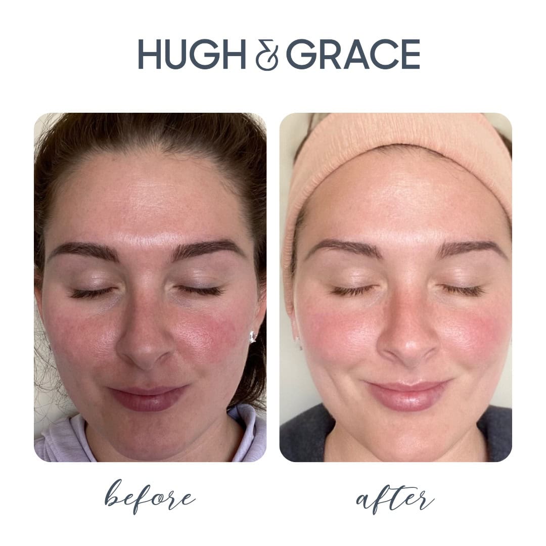Before and after Hugh & Grace skincare