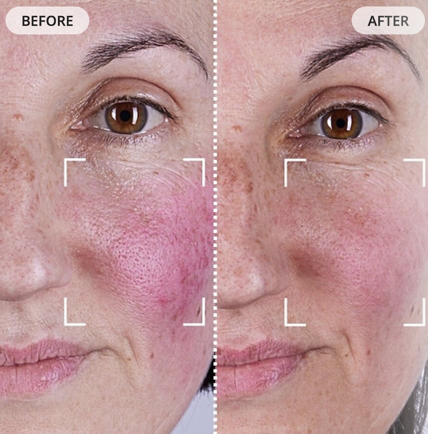currentbody-series-2-rosacea