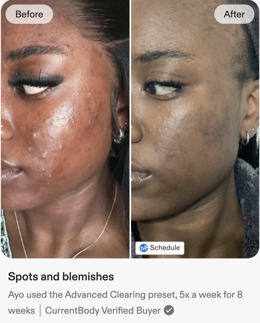 Series 3 Mask Before and After Acne Results