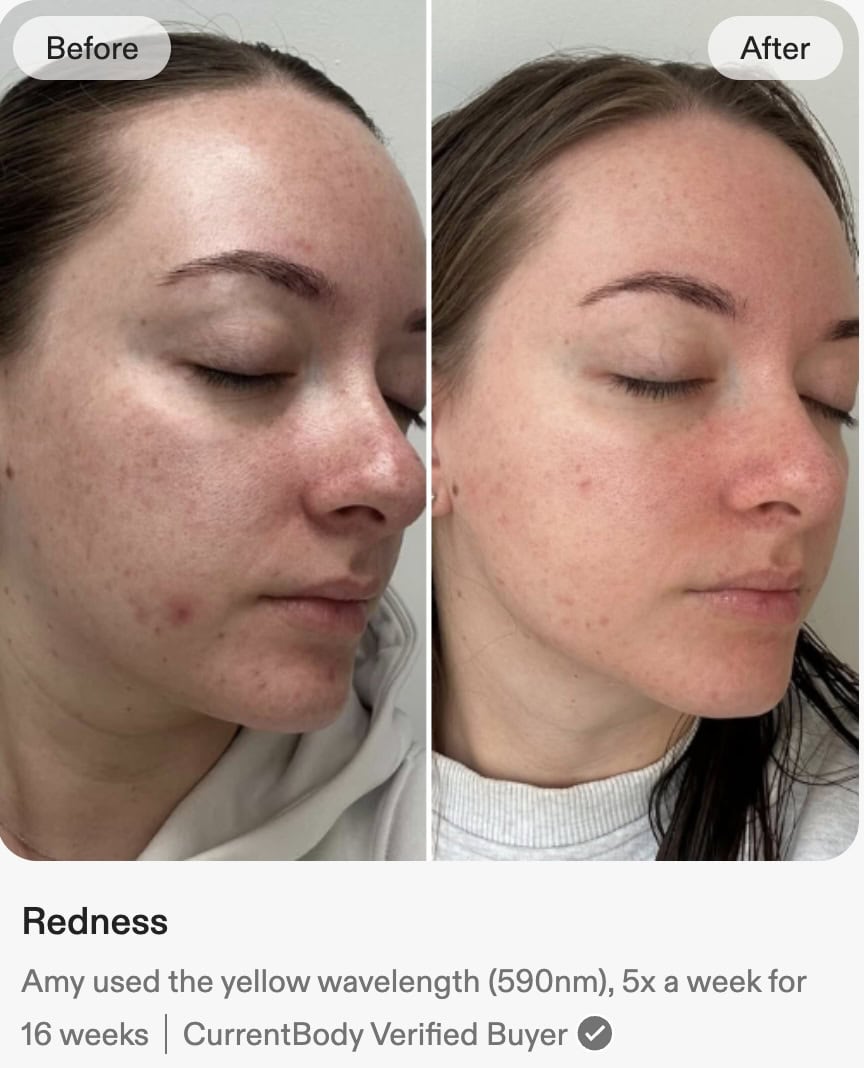 Series 3 Mask Before and After for Acne